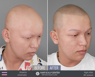SMP สักไรผมสำหรับ อโลพีเชีย(Alopecia) ผมร่วงหย่อมๆ