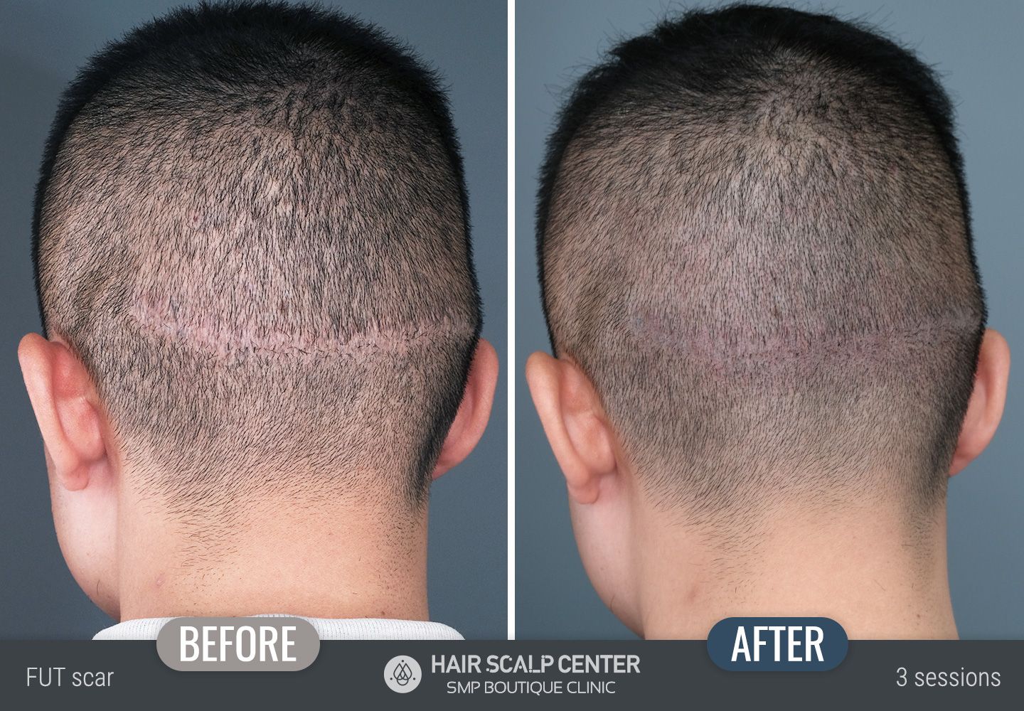 Cover surgical scars from hair transplants with SMP | Hair Scalp Center |  Bangkok, Thailand